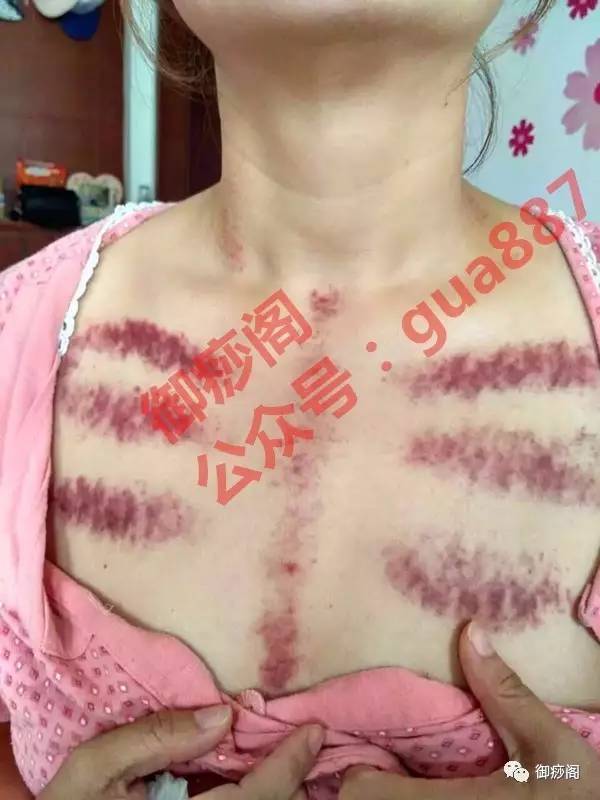 揪頸胸痧揭秘，自然美景探索之旅開啟